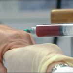 Prp Injections In Dubai