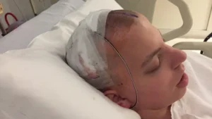 Brain Injury Recovery