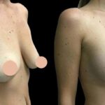 H11-Breast-Augmentation-ezgif.com-webp-to-jpg-converter