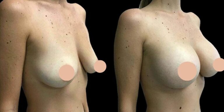 H11-Breast-Augmentation-ezgif.com-webp-to-jpg-converter