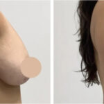 H12-Breast-Lift