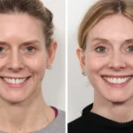 Thread Lift in Dubai: Restoring Facial Contours Naturally