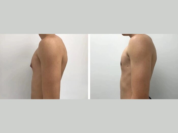 H3-Gynecomastia