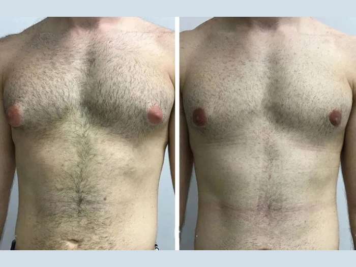 H7-Gynecomastia