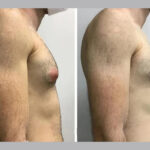 H8-Gynecomastia