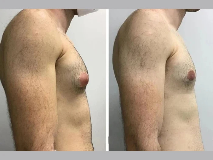 H8-Gynecomastia