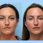 Lift Your Confidence with the Best Plastic Surgeon in Dubai for Thread Lift