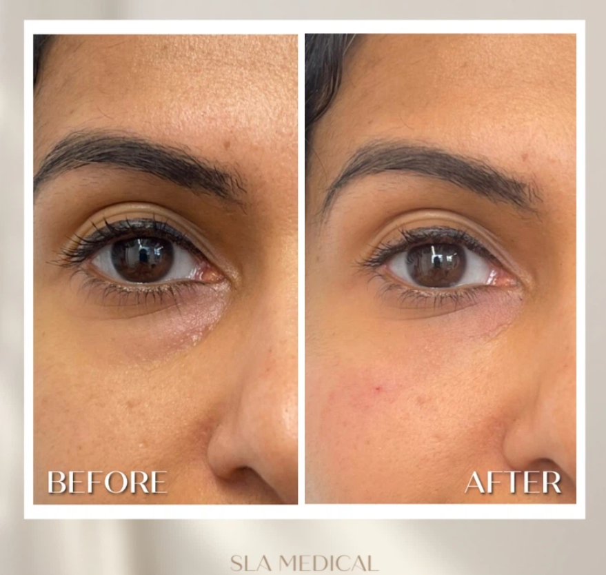 Polynucleotides Under Eyes In Manchester