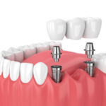 3d render of jaw and implants with dental bridge over white background