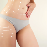 Liposuction in Dubai