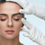 Blepharoplasty Dubai