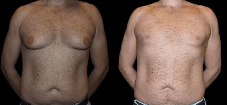 H-Gynecomastia-4