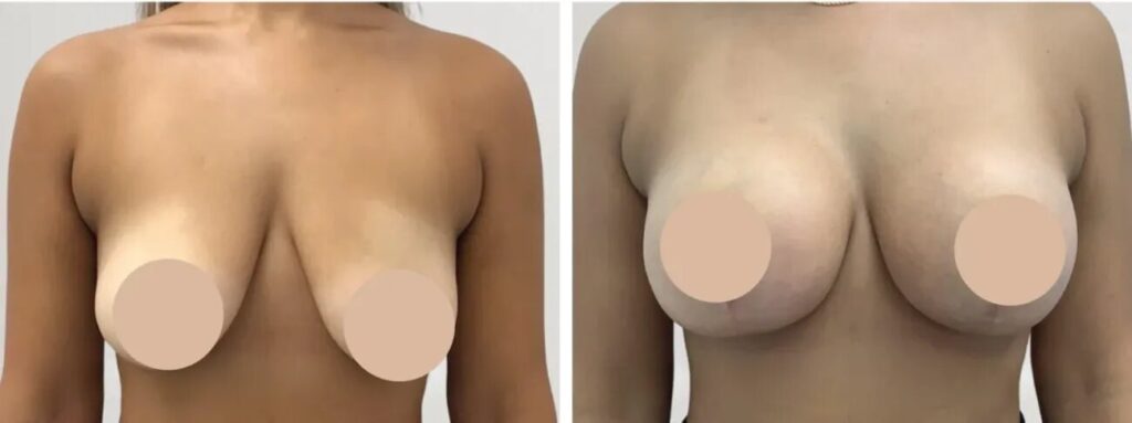 H1-Breast-Lift