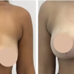 H1-Breast-Lift