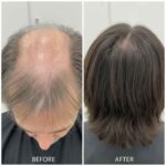 PRP Hair Treatment: Before and After Photos You Need to See