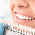 veneer dentistry cost