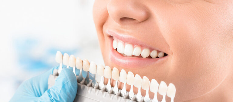 veneer dentistry cost