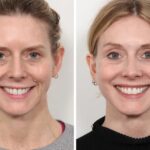 Chemical Peel in Dubai