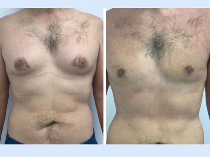 H4-Gynecomastia
