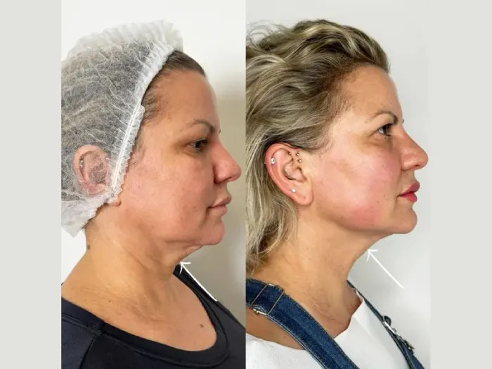 How Endolift in Dubai Delivers Natural-Looking Results