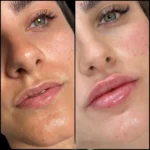 Dermal Fillers in Dubai