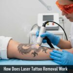 How Does Laser Tattoo Removal Work