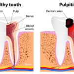 Irreversible Pulpitis