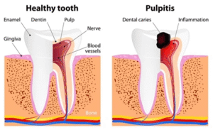 Irreversible Pulpitis