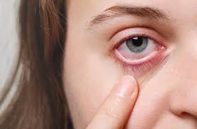 The Complete Blepharitis Alternative Treatment Plan for Clear, Comfortable Eyes