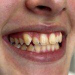Top Signs You Need Orthodontic Treatment