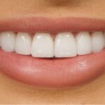 dental-veneers1