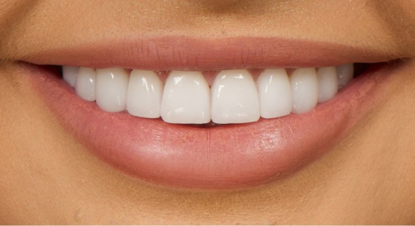 dental-veneers1