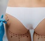 Butt Fat Transfer in Dubai