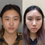 Buccal Fat Removal in Dubai