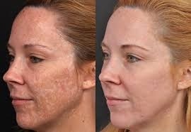 Depigmentation in Altrincham