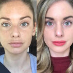 RF-Microneedling in dubai