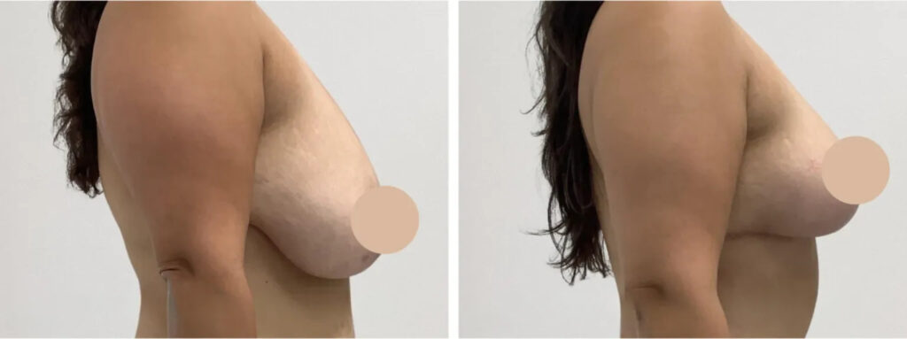 breast lift in Dubai