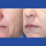 Fractional Radiofrequency Microneedling Dubai
