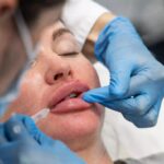 How Often Should You Get Lip Filler Touch-Ups