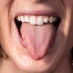 How to Heal Burnt Tongue