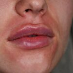How to Reduce Bruising and Swelling After Lip Filler