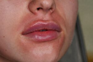 How to Reduce Bruising and Swelling After Lip Filler