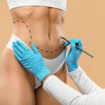 Liposuction-in-Dubai-Results-Week-by-Week-What-to-Expect