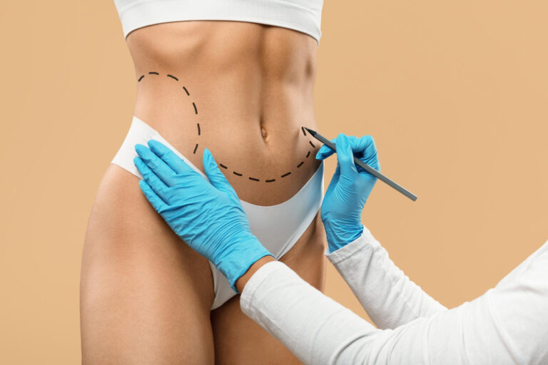 Liposuction-in-Dubai-Results-Week-by-Week-What-to-Expect