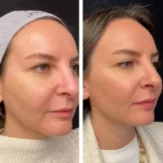 Mesotherapy Treatmen in dubai