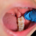 Wisdom Teeth Healing