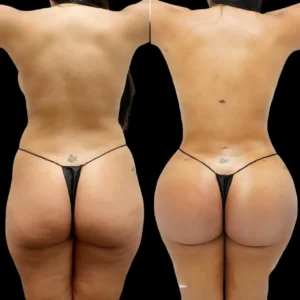 Butt Fat Transfer in Dubai