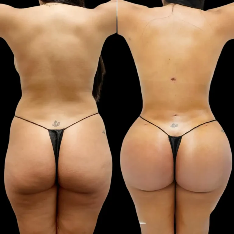 Butt Fat transfer in dubai