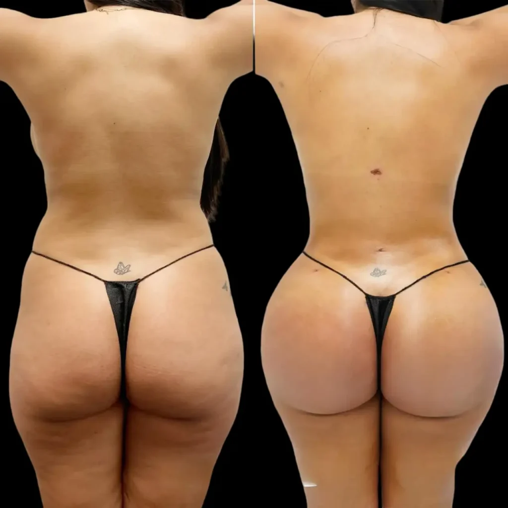 Butt Fat transfer in dubai