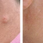 cyst-removal-before-and-after